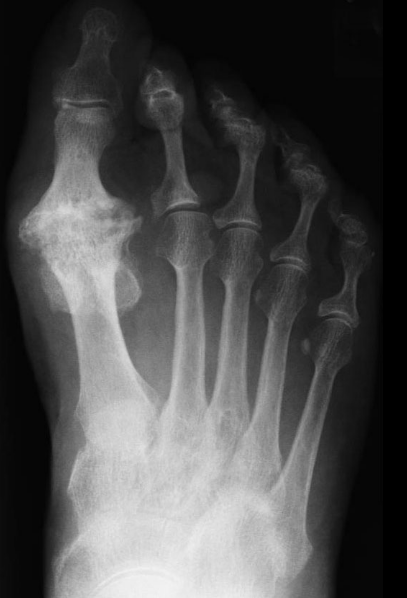 x-ray of hallux limitus