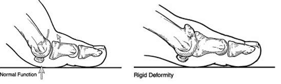 diagram of rigid deformity