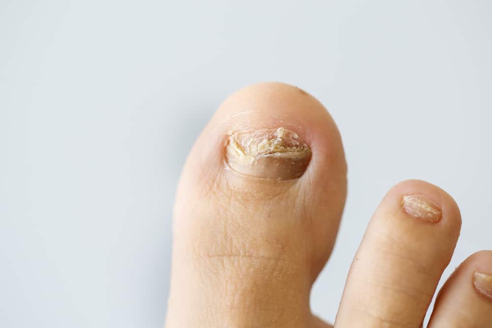 Nail Conditions|Ingrown toenails,fungal nails,thickened & involuted ...