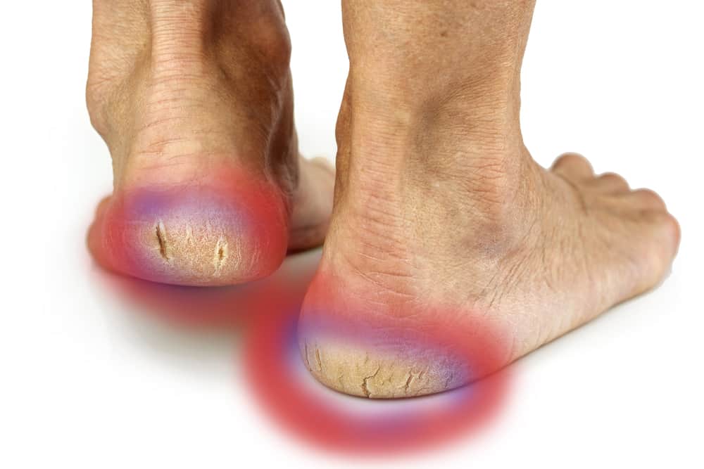 how-to-heal-cracks-and-fissures-on-the-bottom-of-the-foot-or-heel-youtube