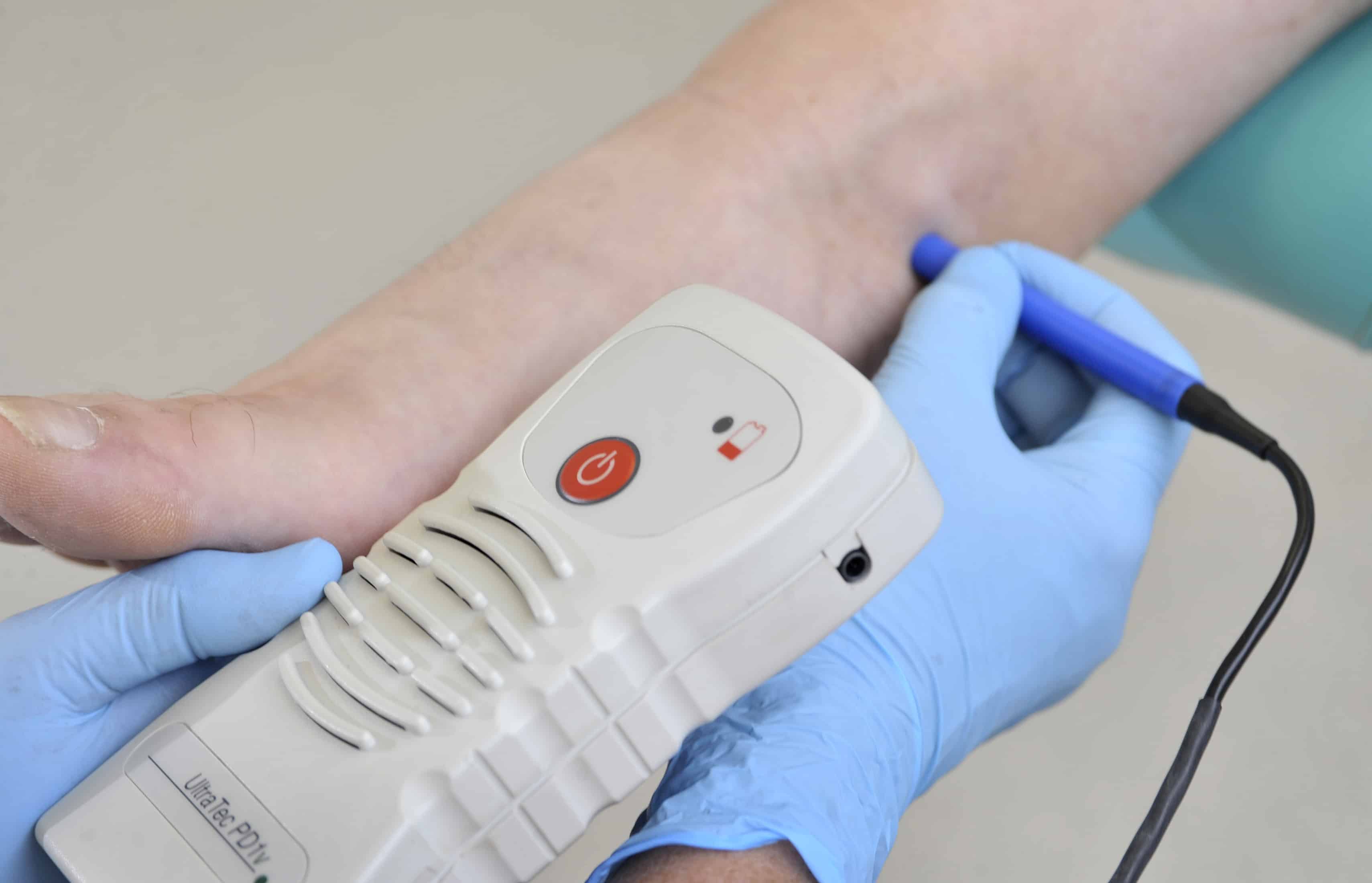 photo of a doppler being used to locate very faint pulses on diabetic foot