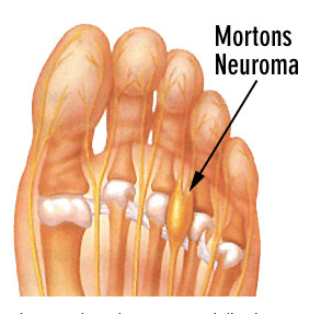 illustration of Morton's neuroma