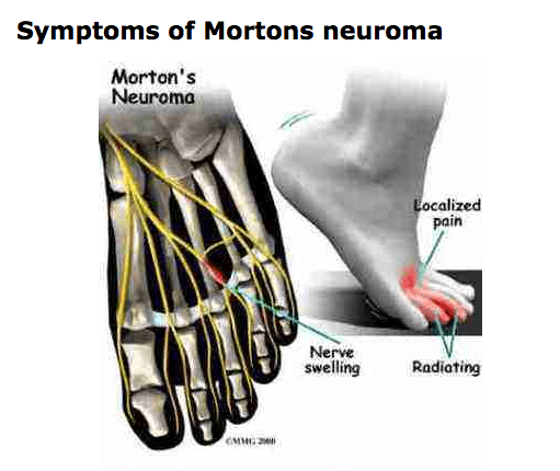 photo showing the symptoms of morton's neuroma