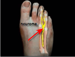 photo of another diagram showing morton's neuroma