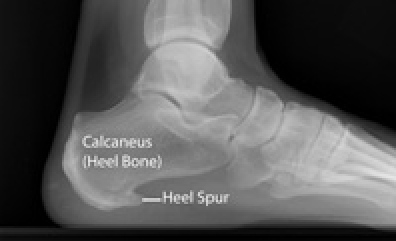 x-ray ofheel spur