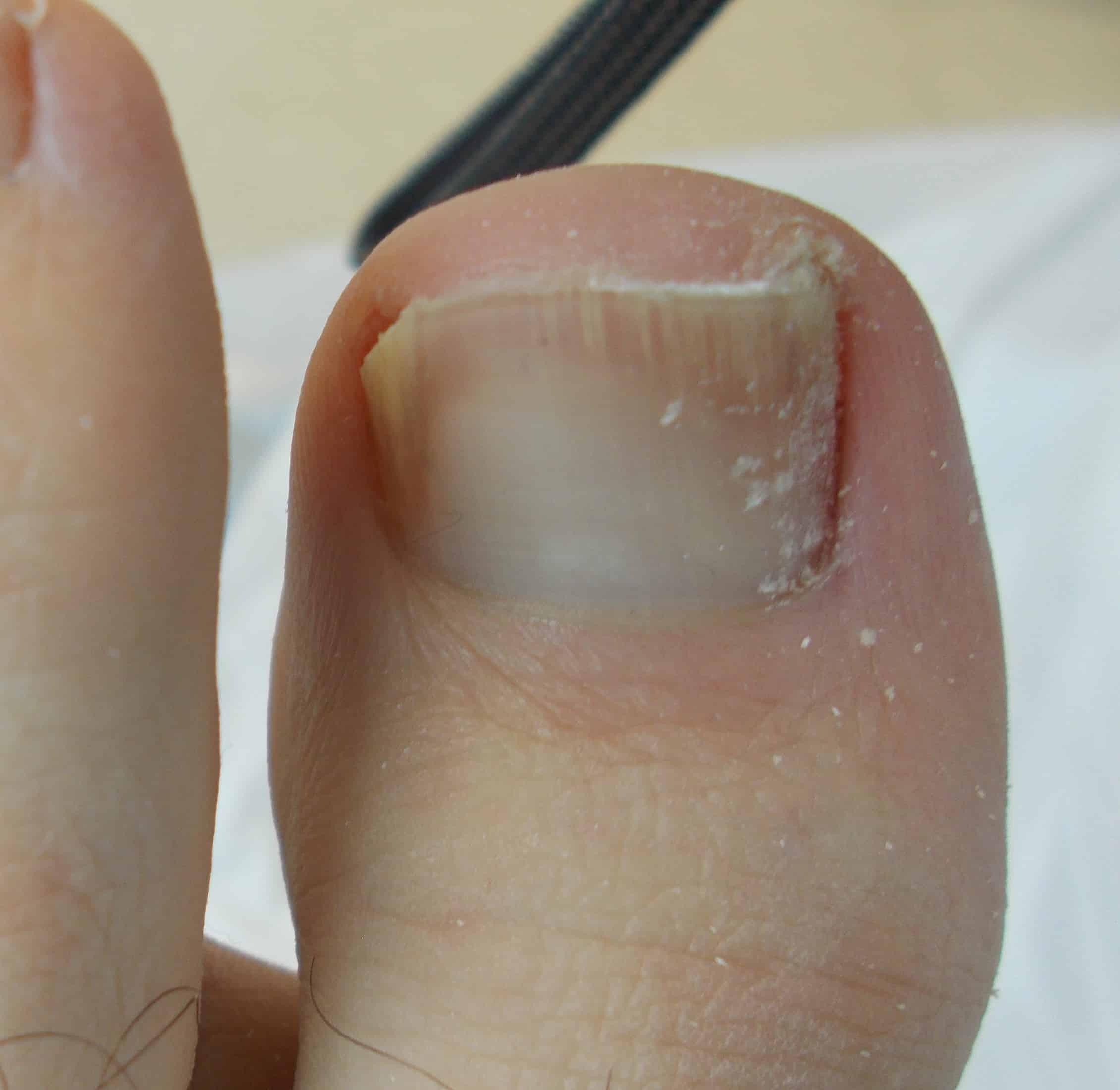 photo of fungal nail pt 3 after