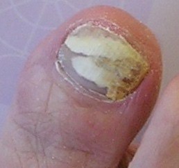 photo of a fungal toe nail before treatment