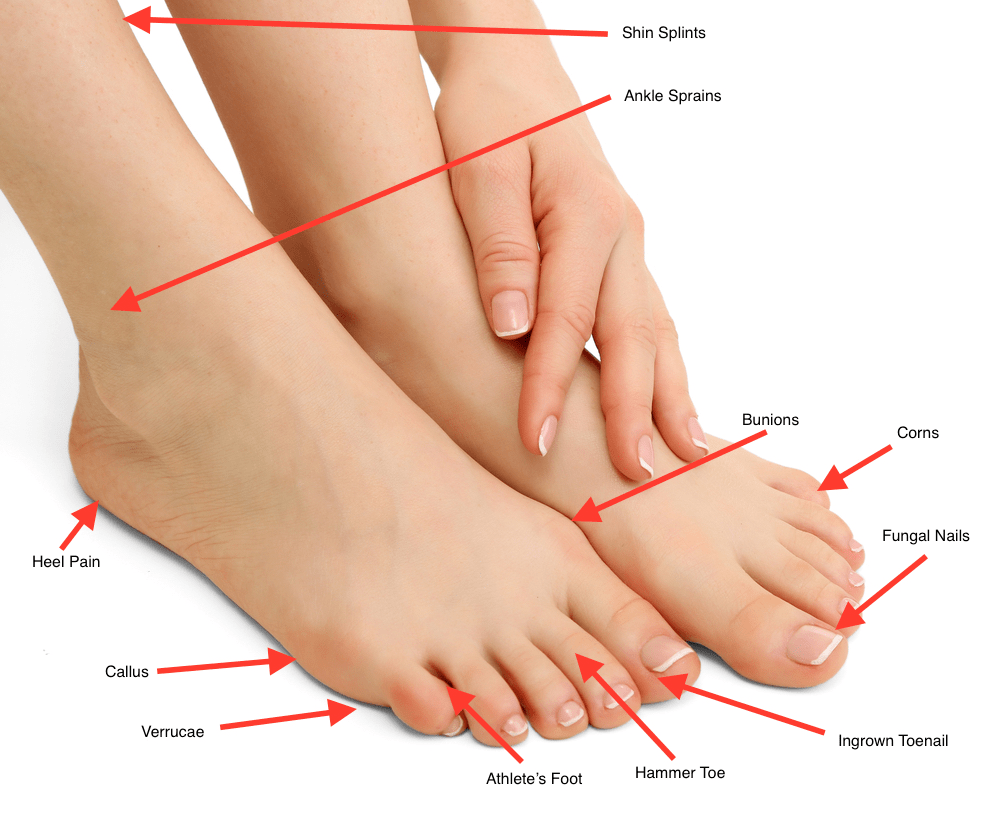 skin fissure ball of foot